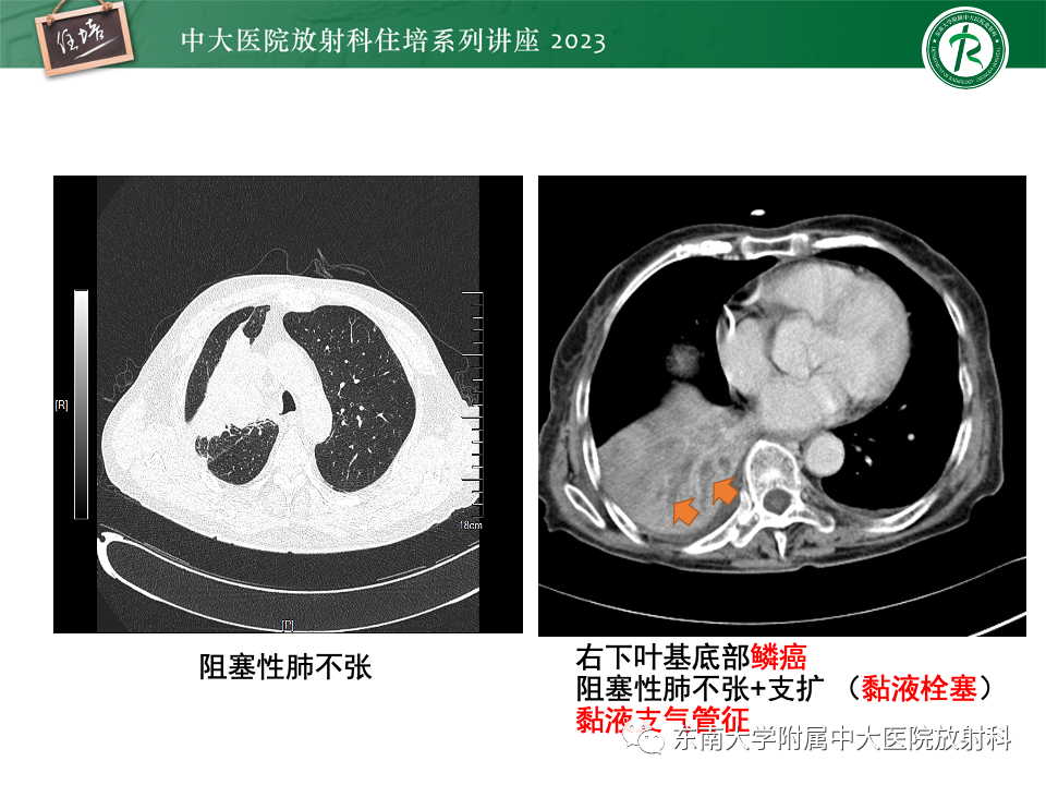 影像PPT - 【PPT】肺癌影像征象及病理分析-23