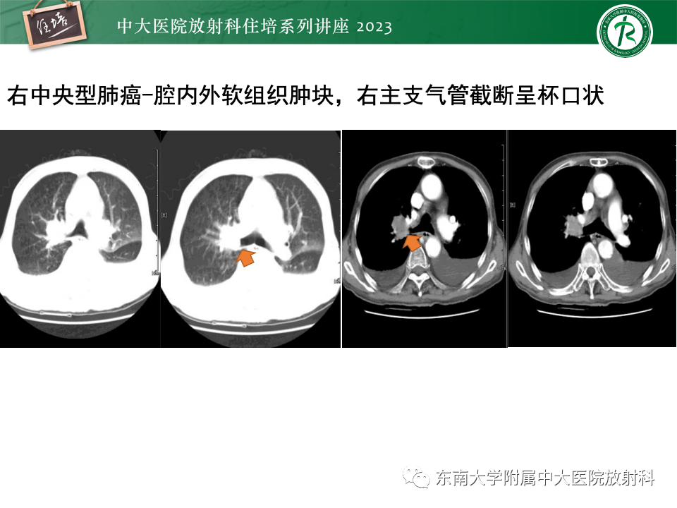 影像PPT - 【PPT】肺癌影像征象及病理分析-24