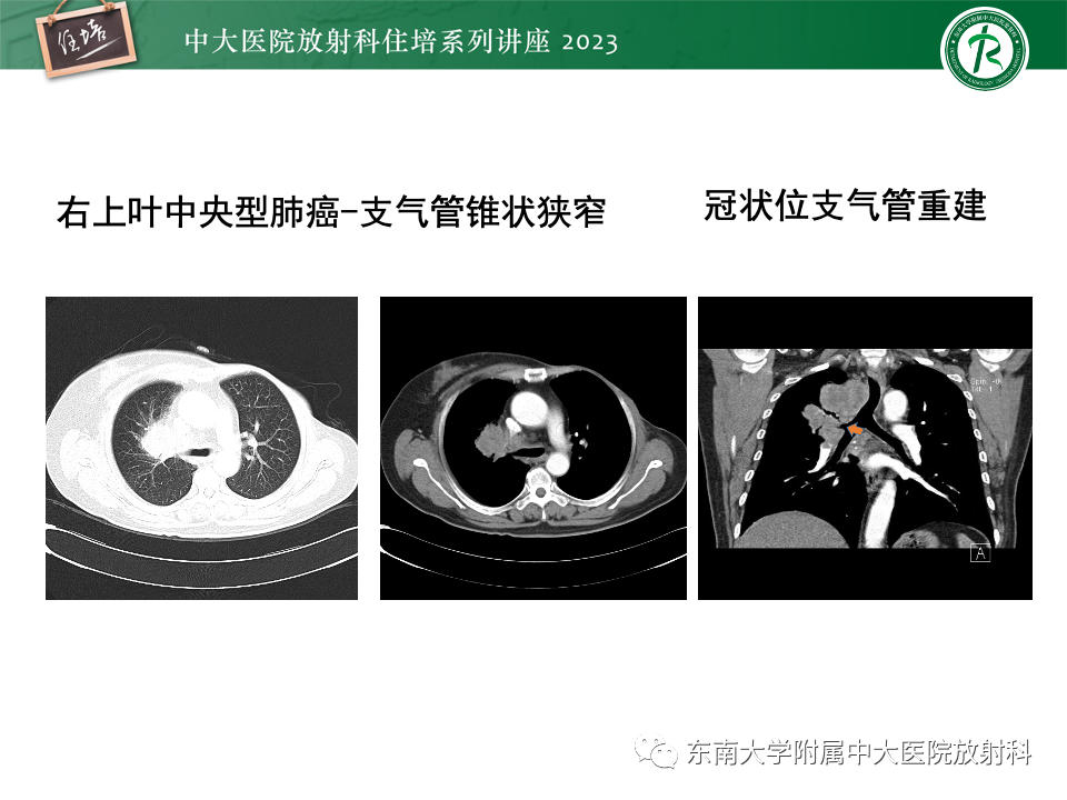 影像PPT - 【PPT】肺癌影像征象及病理分析-25