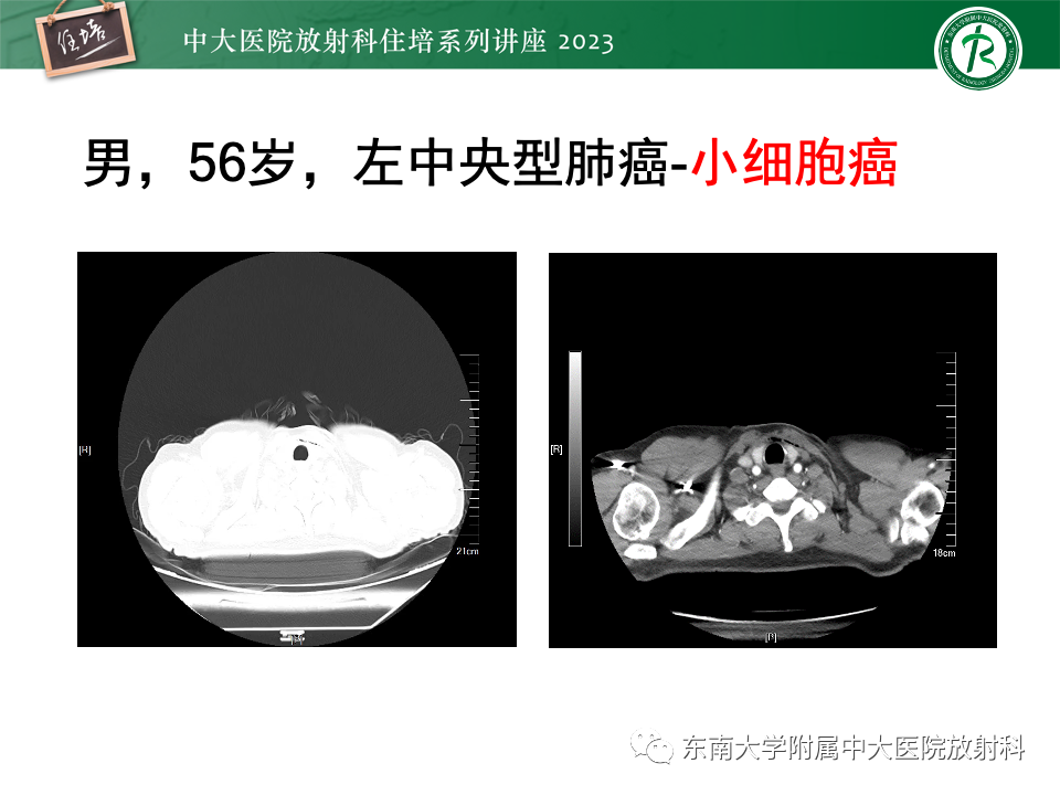 影像PPT - 【PPT】肺癌影像征象及病理分析-27