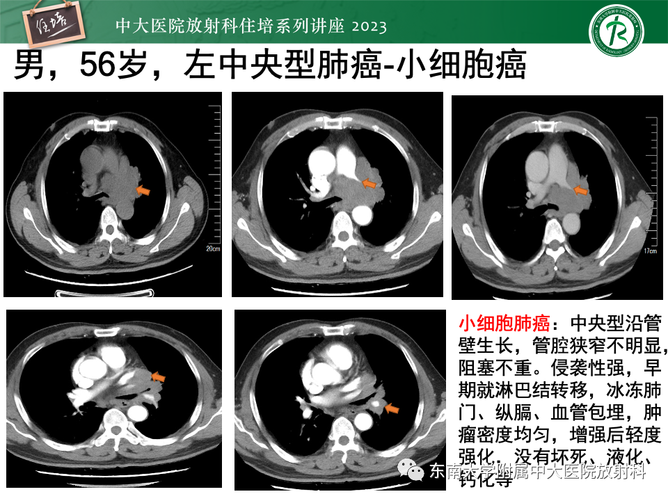 影像PPT - 【PPT】肺癌影像征象及病理分析-28