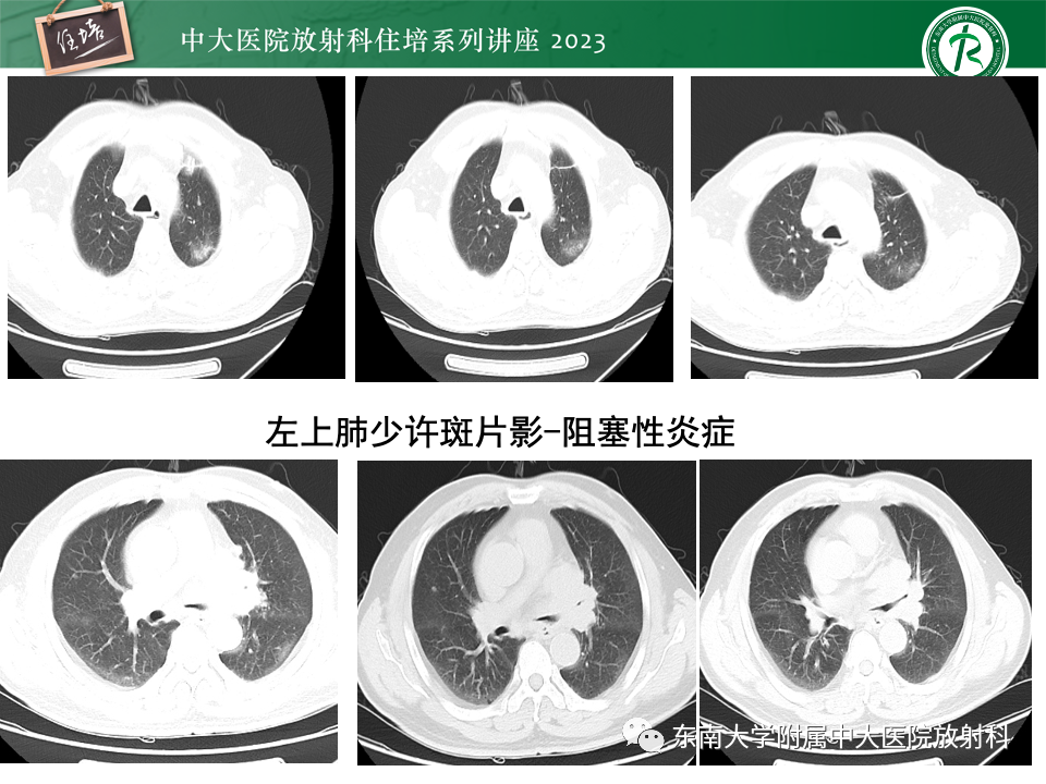 影像PPT - 【PPT】肺癌影像征象及病理分析-29