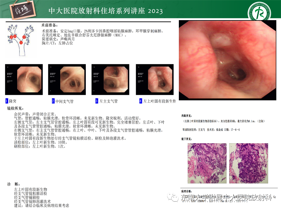 影像PPT - 【PPT】肺癌影像征象及病理分析-30