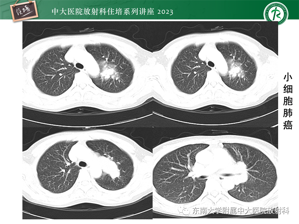 影像PPT - 【PPT】肺癌影像征象及病理分析-31