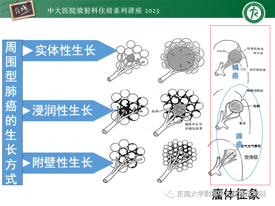 影像PPT - 【PPT】肺癌影像征象及病理分析-36