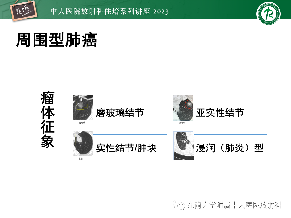 影像PPT - 【PPT】肺癌影像征象及病理分析-37