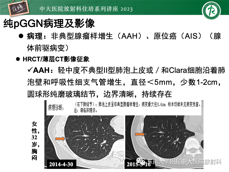 影像PPT - 【PPT】肺癌影像征象及病理分析-38