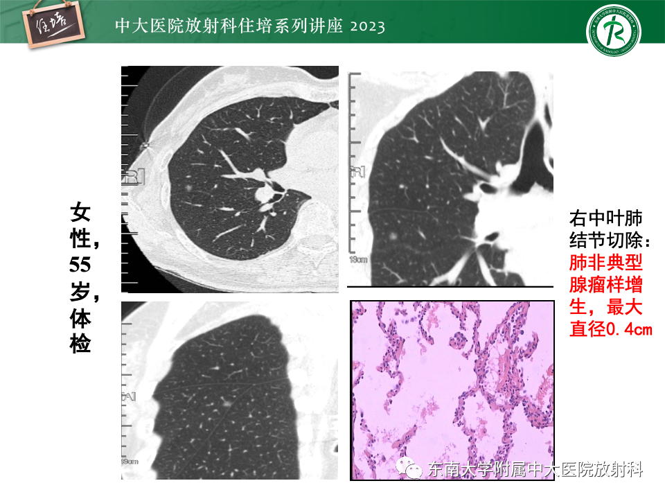 影像PPT - 【PPT】肺癌影像征象及病理分析-39