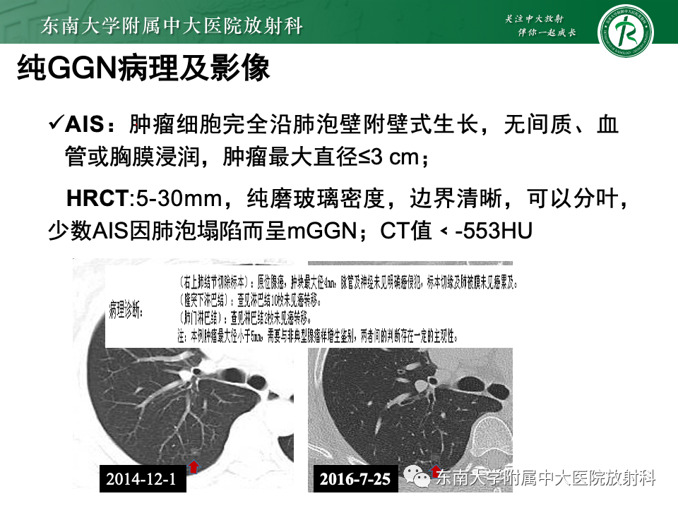 影像PPT - 【PPT】肺癌影像征象及病理分析-40