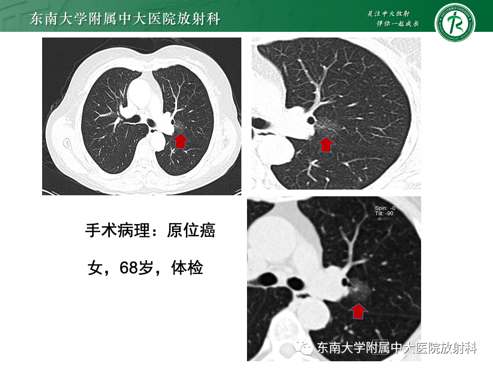 影像PPT - 【PPT】肺癌影像征象及病理分析-41