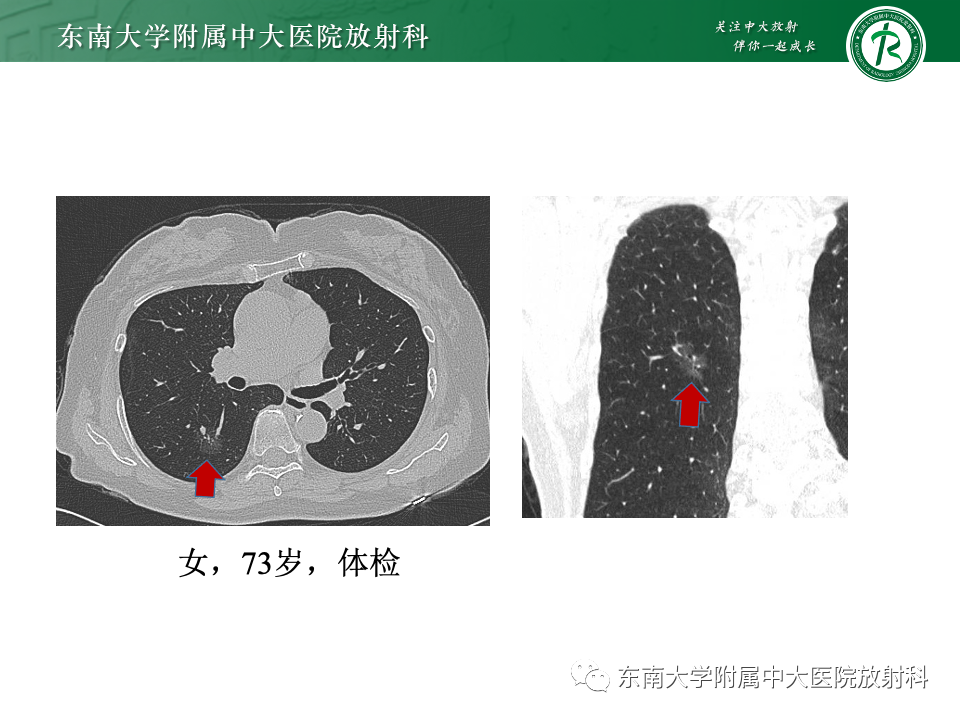 影像PPT - 【PPT】肺癌影像征象及病理分析-42