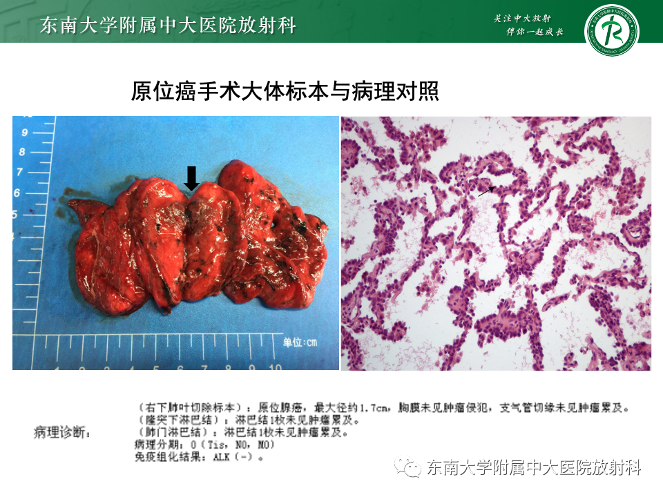 影像PPT - 【PPT】肺癌影像征象及病理分析-43