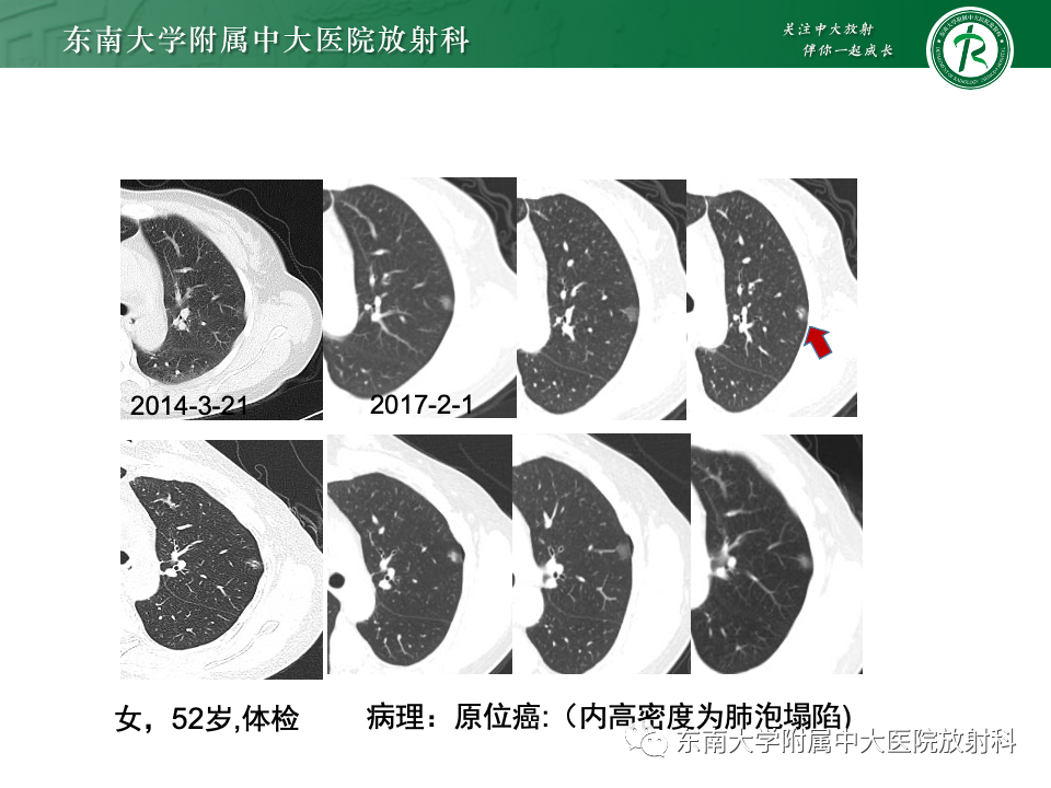 影像PPT - 【PPT】肺癌影像征象及病理分析-44