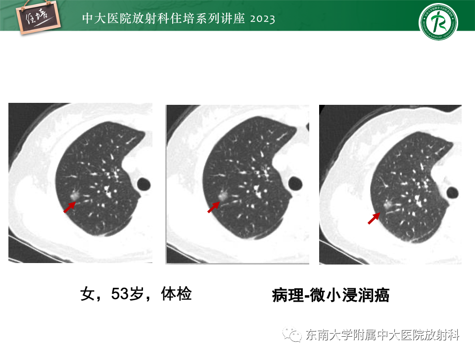 影像PPT - 【PPT】肺癌影像征象及病理分析-46