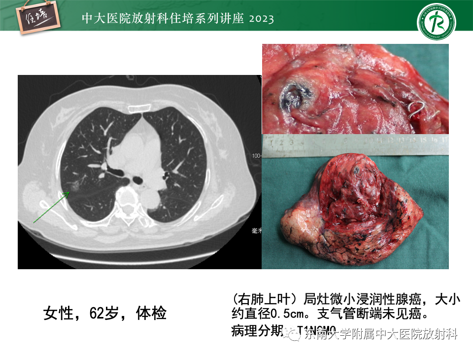 影像PPT - 【PPT】肺癌影像征象及病理分析-47