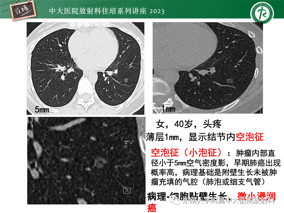影像PPT - 【PPT】肺癌影像征象及病理分析-48