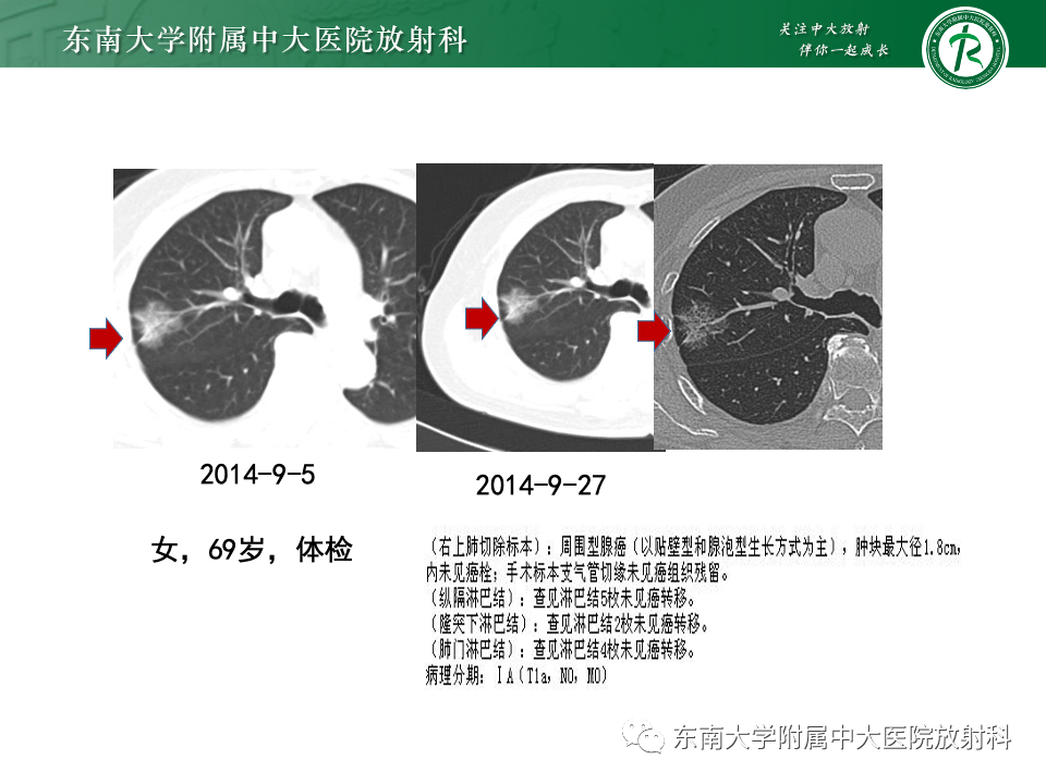 影像PPT - 【PPT】肺癌影像征象及病理分析-50