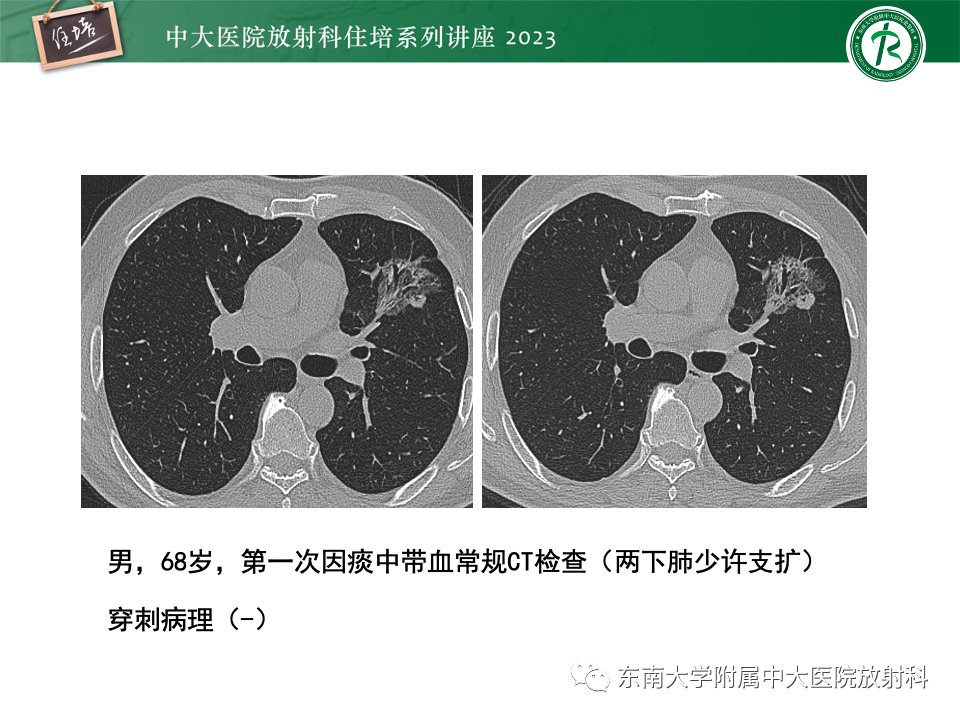 影像PPT - 【PPT】肺癌影像征象及病理分析-51