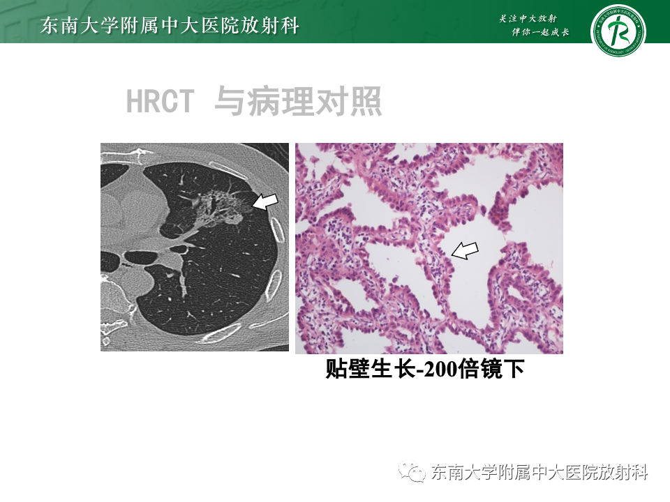 影像PPT - 【PPT】肺癌影像征象及病理分析-53