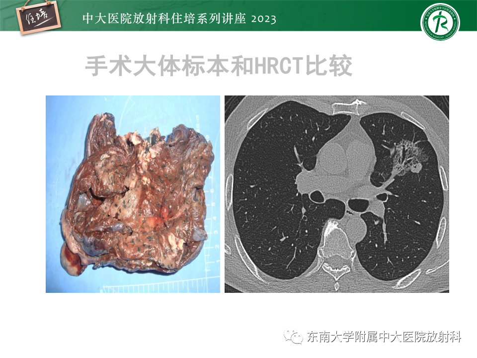 影像PPT - 【PPT】肺癌影像征象及病理分析-52