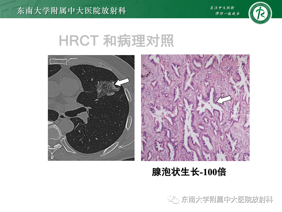 影像PPT - 【PPT】肺癌影像征象及病理分析-54
