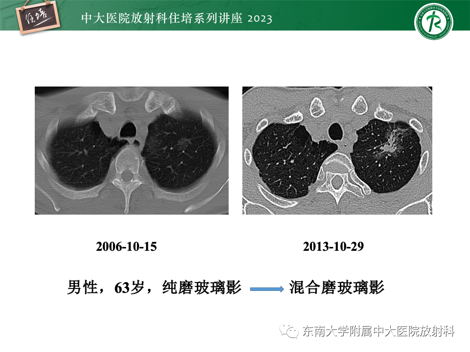 影像PPT - 【PPT】肺癌影像征象及病理分析-56