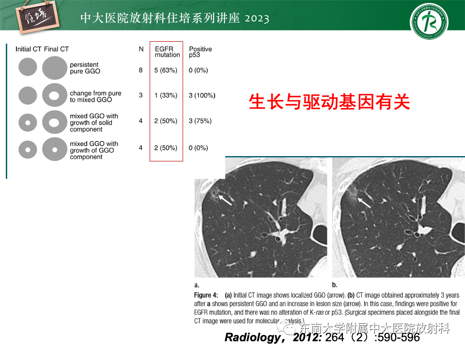 影像PPT - 【PPT】肺癌影像征象及病理分析-57