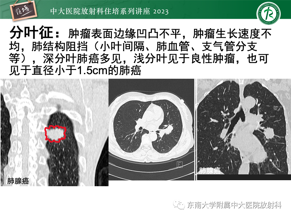 影像PPT - 【PPT】肺癌影像征象及病理分析-59