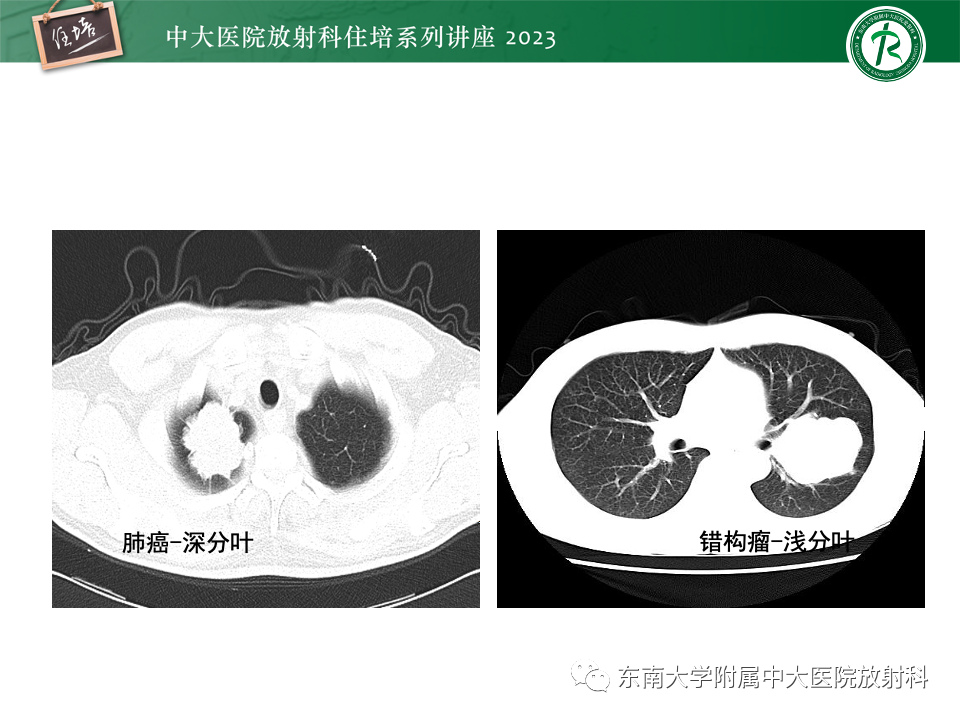 影像PPT - 【PPT】肺癌影像征象及病理分析-60