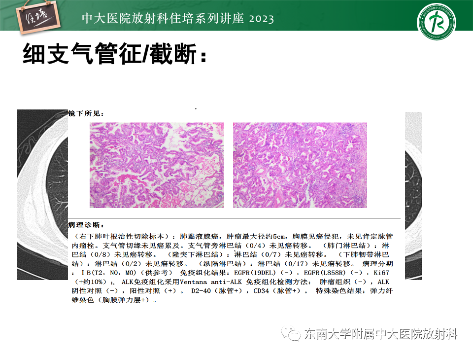 影像PPT - 【PPT】肺癌影像征象及病理分析-62