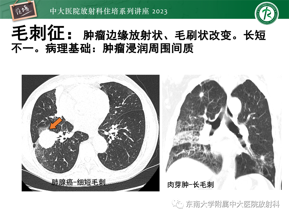 影像PPT - 【PPT】肺癌影像征象及病理分析-61