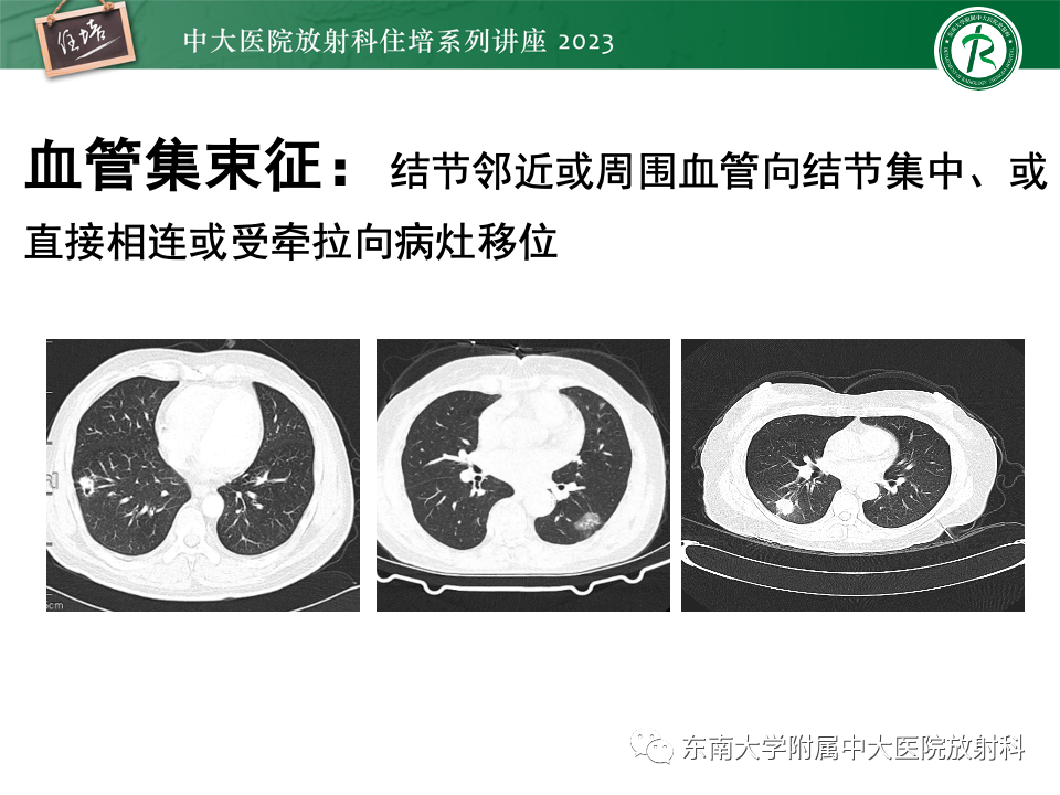 影像PPT - 【PPT】肺癌影像征象及病理分析-63