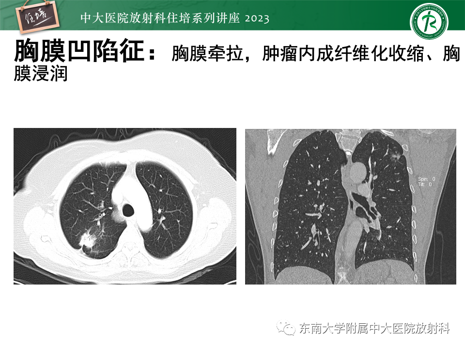 影像PPT - 【PPT】肺癌影像征象及病理分析-64