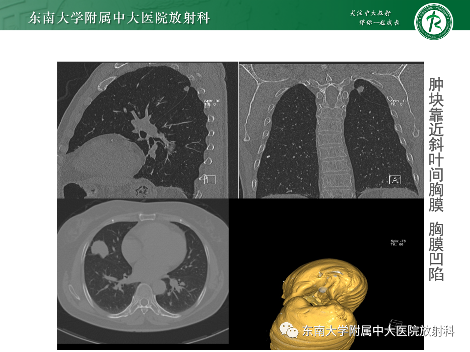 影像PPT - 【PPT】肺癌影像征象及病理分析-65