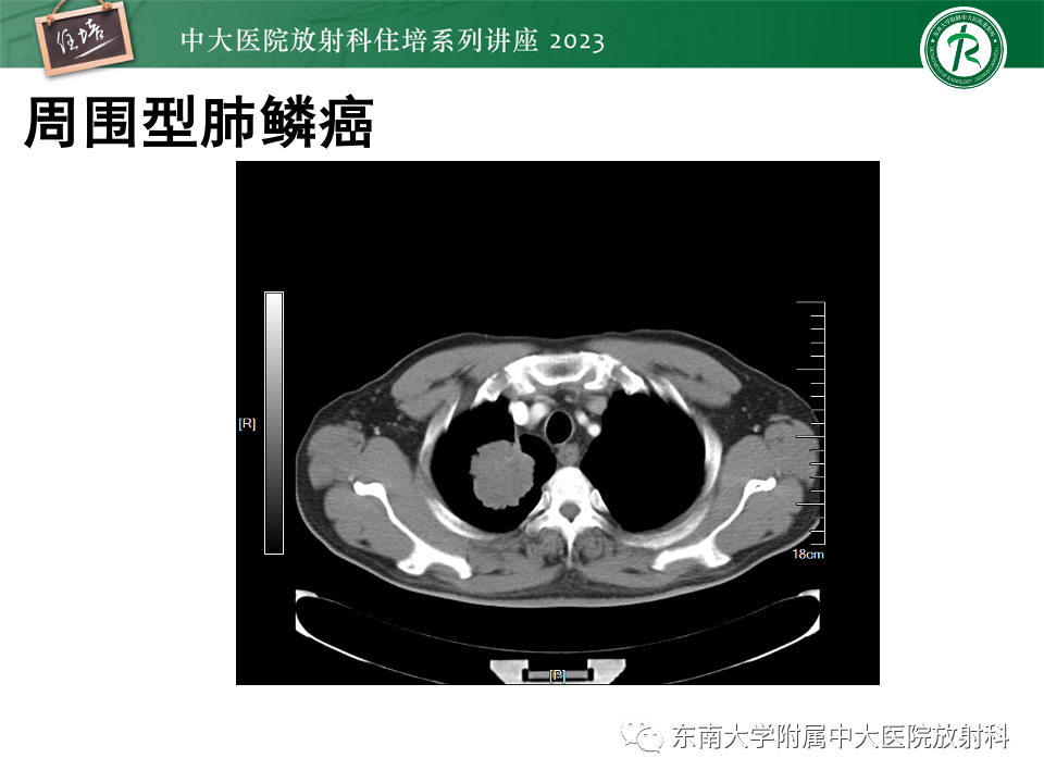 影像PPT - 【PPT】肺癌影像征象及病理分析-67