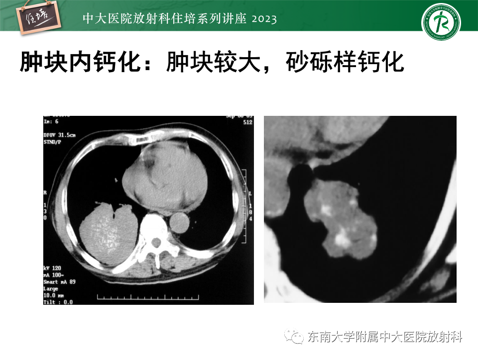 影像PPT - 【PPT】肺癌影像征象及病理分析-66