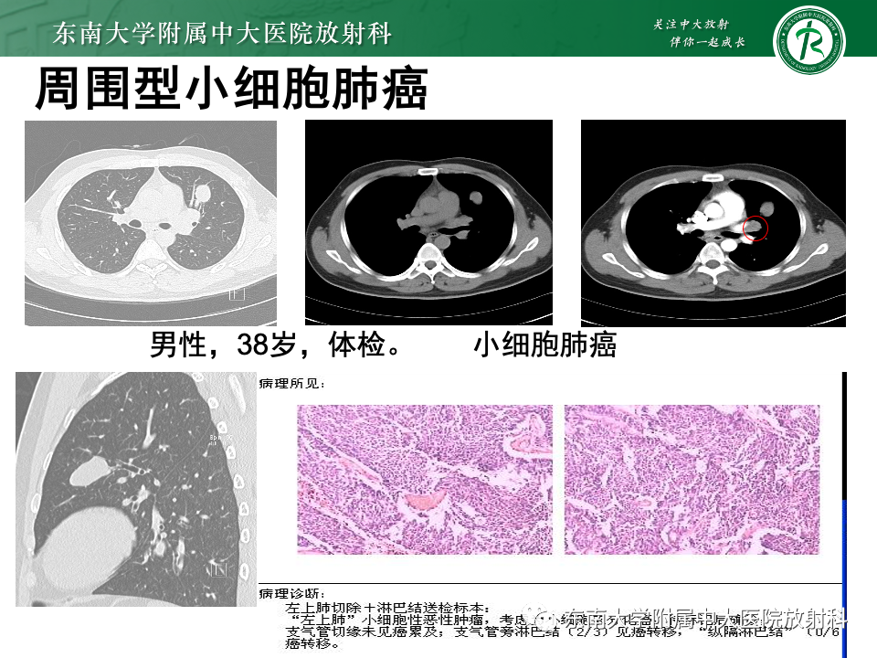 影像PPT - 【PPT】肺癌影像征象及病理分析-69