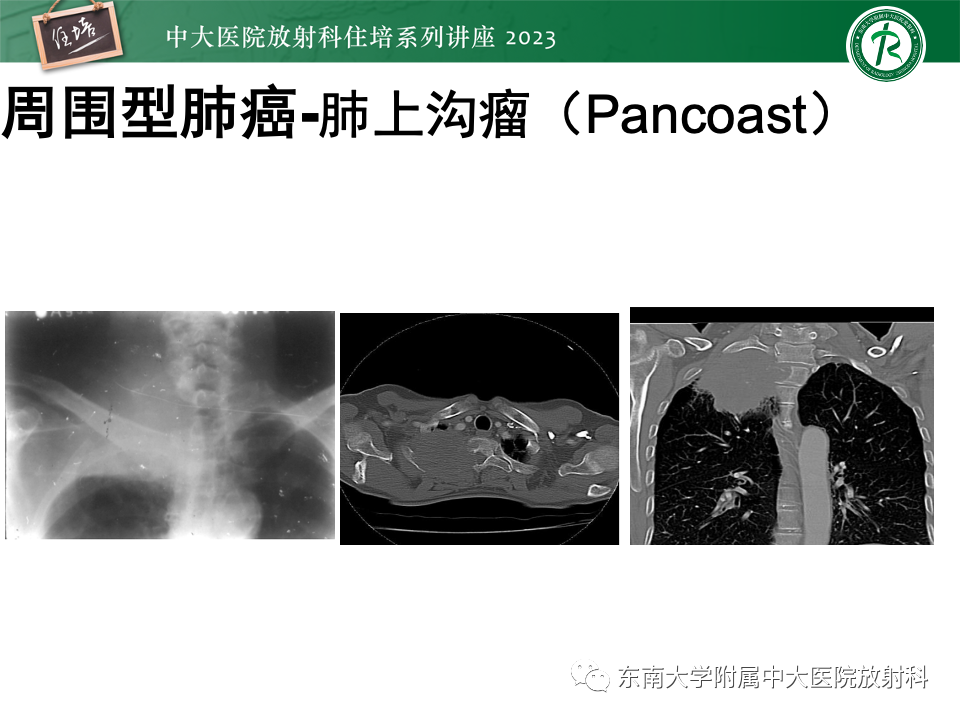 影像PPT - 【PPT】肺癌影像征象及病理分析-72