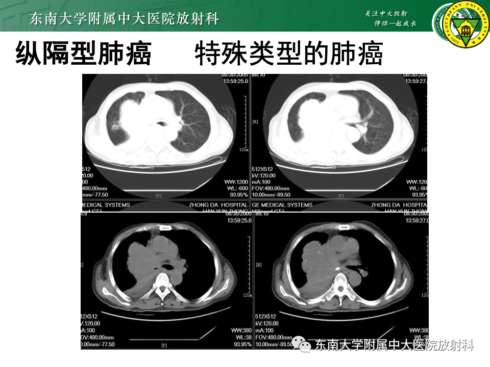 影像PPT - 【PPT】肺癌影像征象及病理分析-73