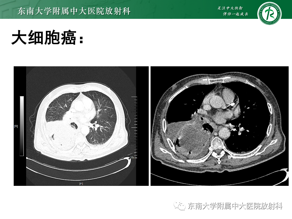 影像PPT - 【PPT】肺癌影像征象及病理分析-70