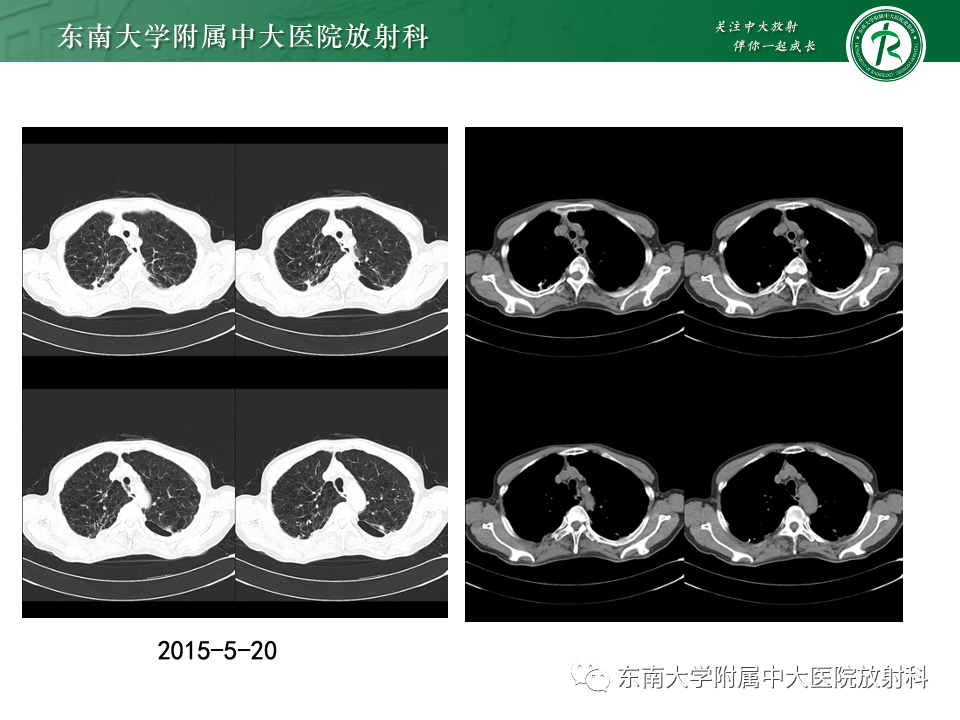 影像PPT - 【PPT】肺癌影像征象及病理分析-75