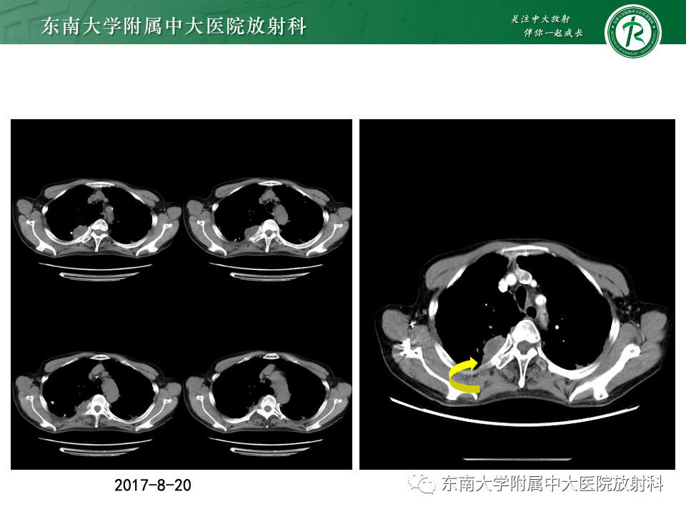 影像PPT - 【PPT】肺癌影像征象及病理分析-76