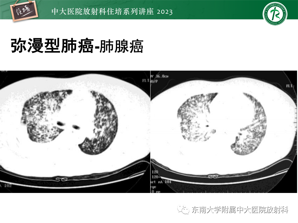 影像PPT - 【PPT】肺癌影像征象及病理分析-78