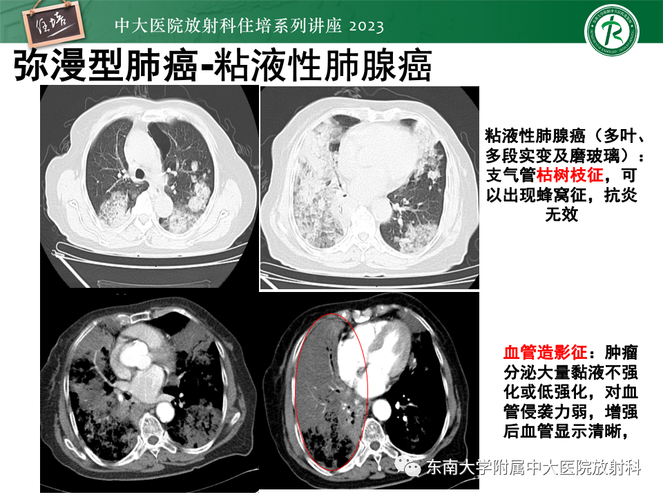 影像PPT - 【PPT】肺癌影像征象及病理分析-79
