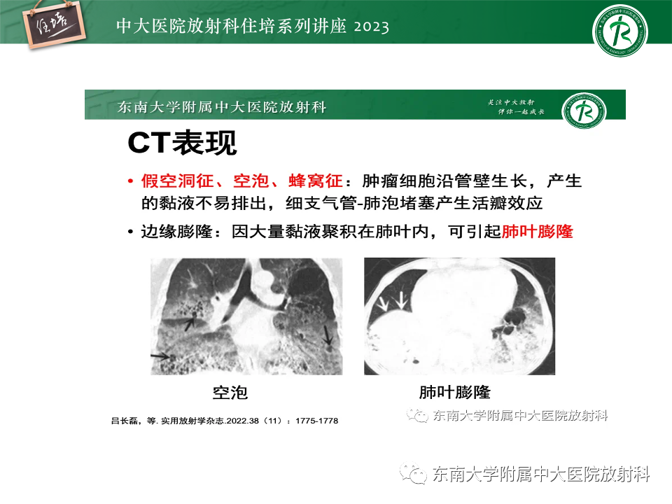 影像PPT - 【PPT】肺癌影像征象及病理分析-80