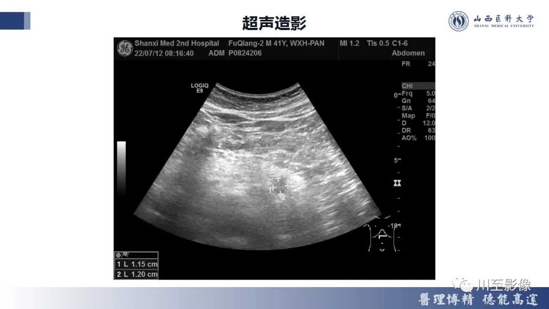 影像PPT - 【PPT】胰腺神经内分泌肿瘤-5