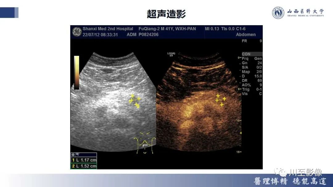 影像PPT - 【PPT】胰腺神经内分泌肿瘤-6