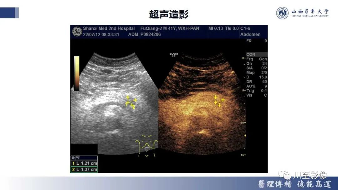 影像PPT - 【PPT】胰腺神经内分泌肿瘤-7