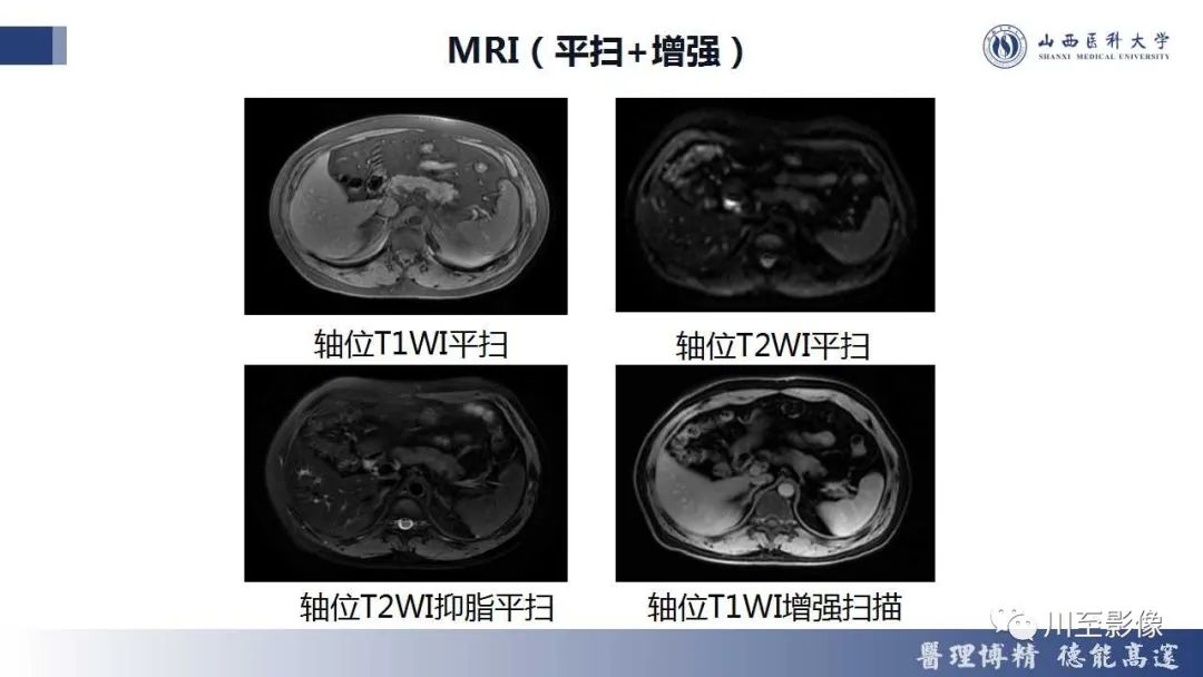 影像PPT - 【PPT】胰腺神经内分泌肿瘤-8