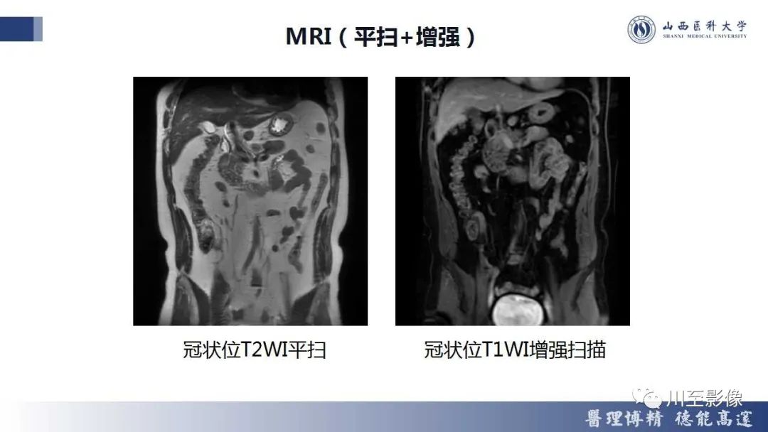 影像PPT - 【PPT】胰腺神经内分泌肿瘤-9